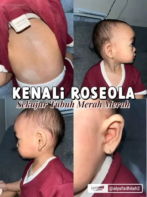 Kenali Roseola Ayuk para ibuk mengetahui penyakit agar lebih aware lagi. Penanga