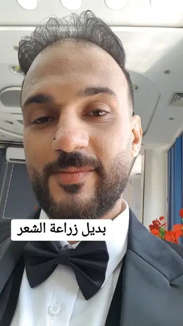 بديل زراعة الشعر 💫 يوم فرحي @مركز كارلى للتجميل 