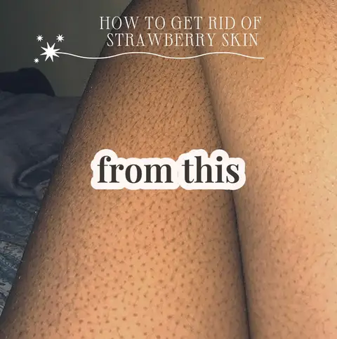 #ketosispilaris #strawberryskin #skincare #fyp #viral #eucerin #cerave #laroshep