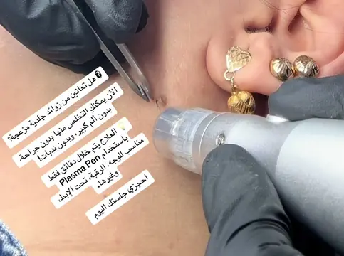 #PlasmaPen   #PlasmaLifting   #FibroblastTherapy   #NonSurgicalLift   #PlasmaSki