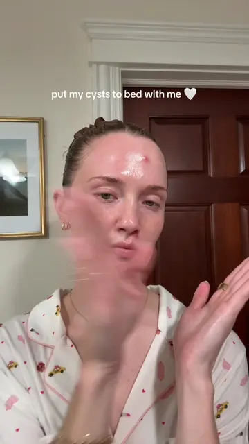 we may have a popportunity (get it?)! #cysticacne #acnejourney #acnetreatment #a