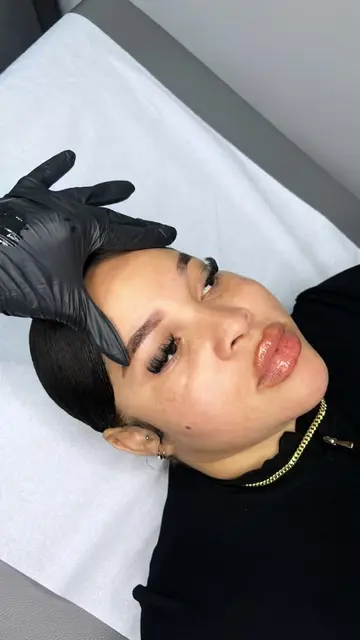 #lipfillers #lipfillerJamaica@Cosmeticnursealicia 