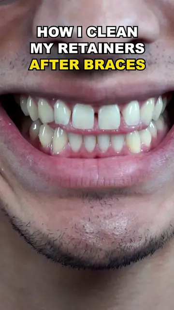 So much better!!  #gaptaincrunch #viral #fyp #TikTokShopCreatorPicks #braces 