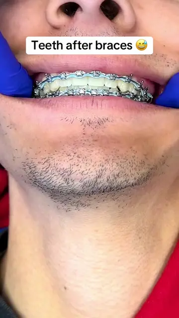 How do they look!? 😅 #gaptaincrunch #fyp #viral #TikTokShopCreatorPicks #teethw