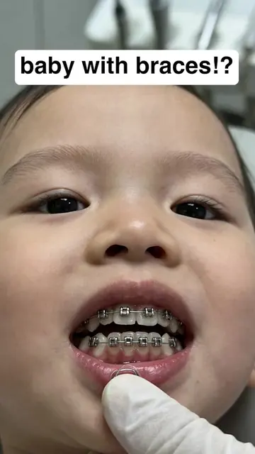 That’s crazy 😭 #gaptaincrunch #fyp #viral #braces #bracesoff 