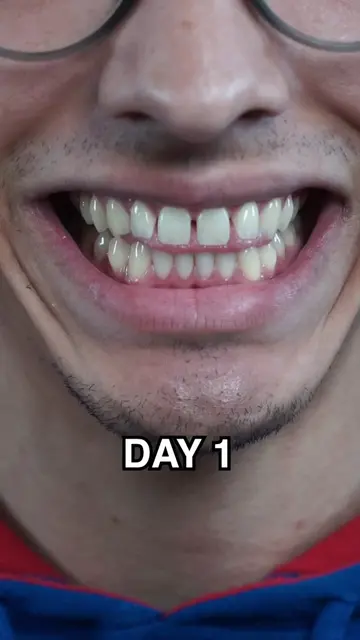 Was it worth it!? 😭 #viral #fyp #braces #gaptaincrunch #bracesoff 