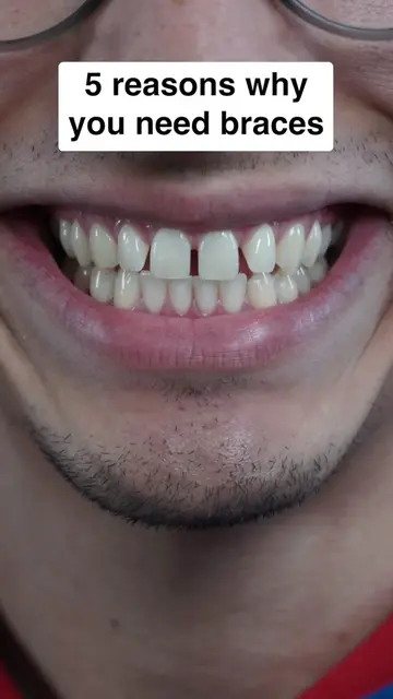 This will make you want braces 😬 #viral #fyp #gaptaincrunch #braces #bracesoff 