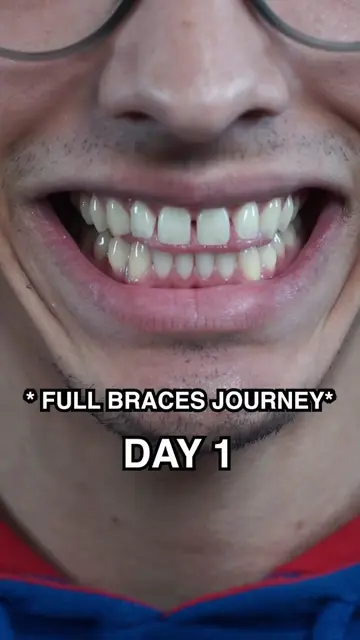 The results 🥹 #viral #fyp #gaptaincrunch #braces #bracesoff 