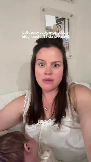 Bell’s palsy journey postpartum update #bellspalsyrecovery 