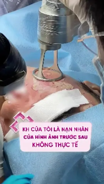 KHÁCH HÀNG CỦA TÔI LÀ NẠN NHÂN CỦA HÌNH ẢNH TRƯỚC SAU KHÔNG THỰC TẾ #sẹo #sẹorỗ 