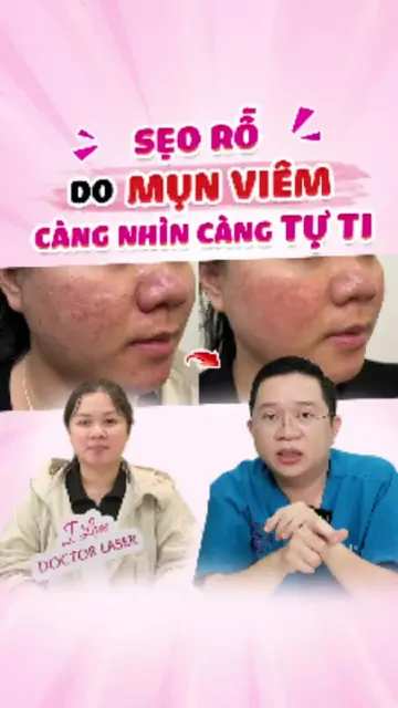 SẸO RỖ DO MỤN VIÊM CÀNG NHÌN CÀNG TỰ TI #sẹo #sẹorỗ #laserco2 #doctorlaser #bslu