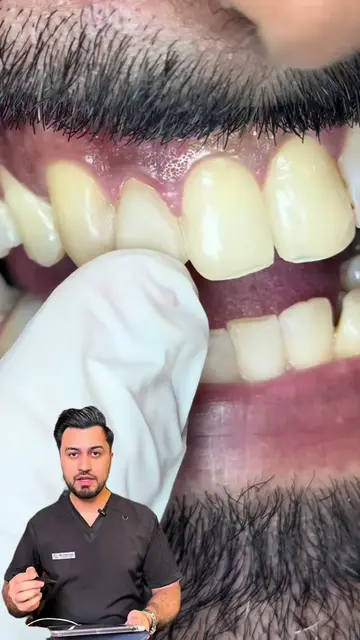 Case discussion ( immediate Implant Placement ) | #drharoonshah #foryou #LearnOn