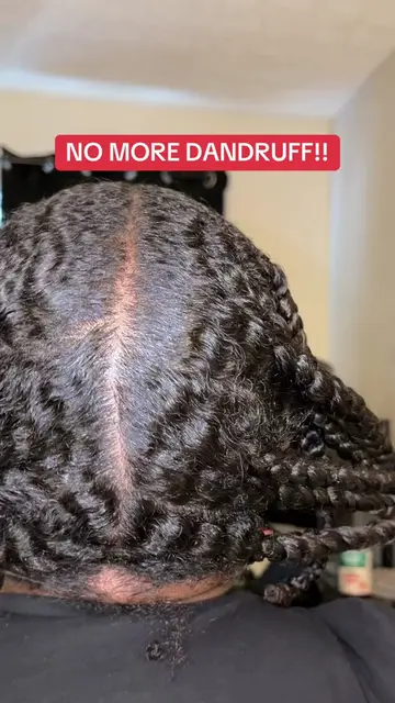MY SCALP IS SO MUCH BETTER!! #psoriasis #psoriasisawareness #scalppsoriasis #dry
