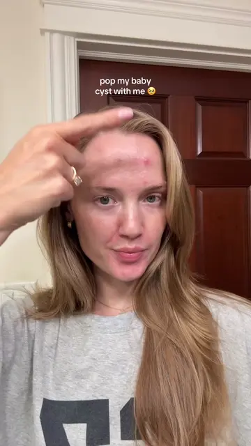 I’M SO HAPPY!!! LIB for the salve! 🧡 #pimplepopping #cysticacne #acnetreatments