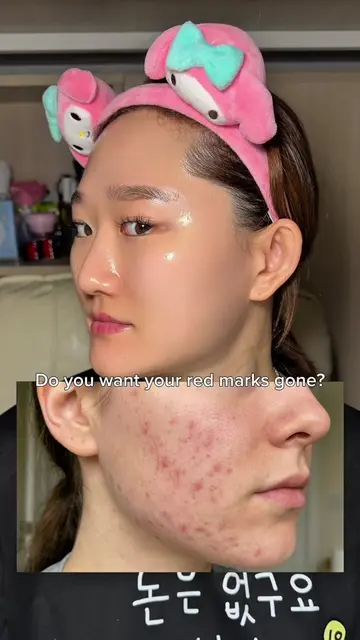Korean EGF serum to repair red marks Dear, Klairs Blue EGF Repair Serum is a lig