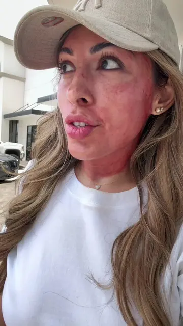 2nd treatment of microneedling with PDGF #microneedling #glowskin #skintreatment