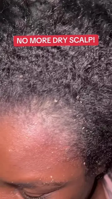 LOOK AT THE DIFFERENCE! My scalp has come a long way! #dryscalp #psoriasis #psor