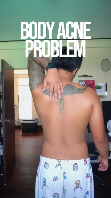 Body acne problem i got you! #icelerskin 