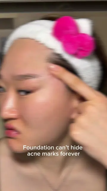 Korean EGF serum to repair red marks Foundation can hide acne marks for a moment