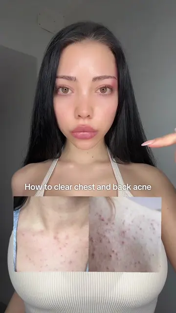 How to improve chest and back acne ✨                                            