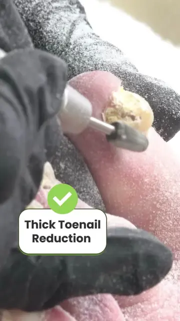 Not all pedicures are pretty- and that’s okay!  Reduce thick nails and callus ea