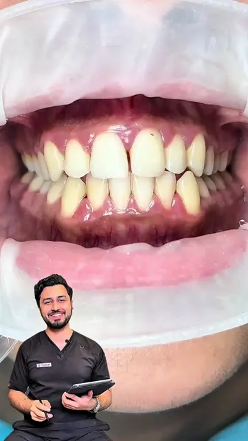 Composite Bonding for Diastema Closure and incisal Edge Reconstruction 🦷🇵🇰 | 