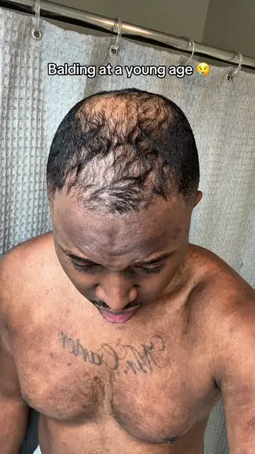 Don’t give up 😢 #hairgrowth #hairloss #hairthinning #balding #dealsforyoudays  
