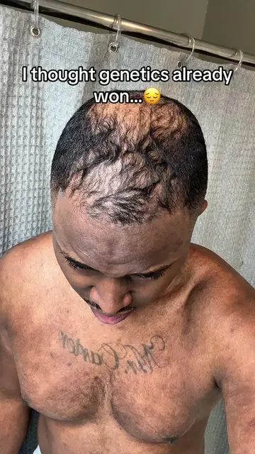 Don’t let your genetics win.  😤💪🏾 #hairloss #hairgrowth #hairthinning #baldin