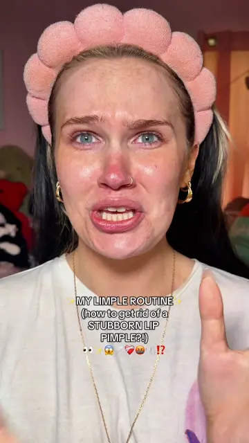 miss limple is back…and SHES PISSED😫 do YOU get lip pimples?!👀 @Hero Cosmetics