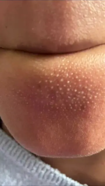 Masque a l'argile Medicube. Nettoyage des portes de la peau en profondeur.