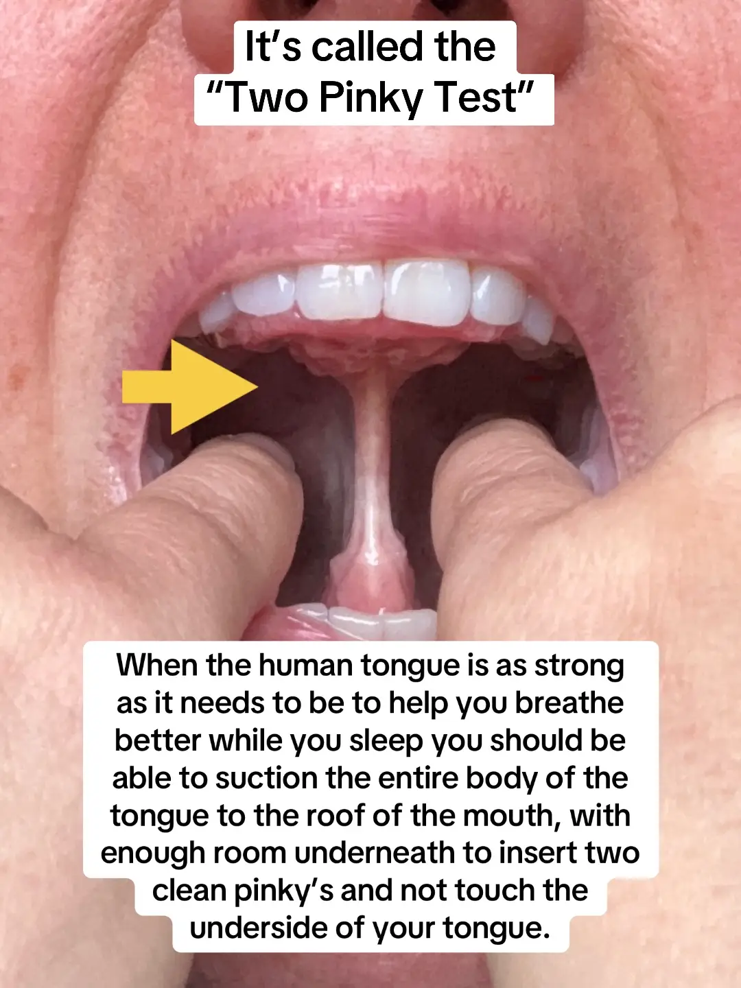 Simply slide your pinky’s onto the top of the lower molars and see if the tops o