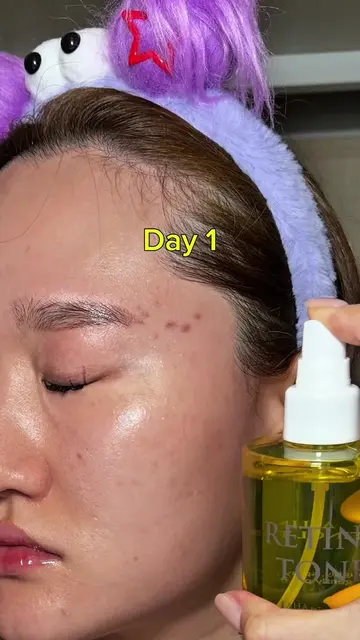 Soothing and healing acne spray @APLIN Store US #kbeauty #skintok #acneproneskin