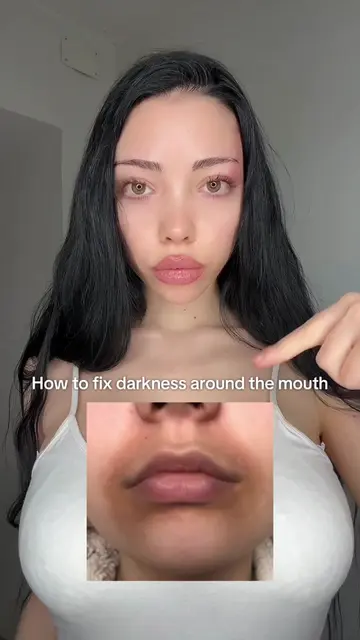 nobody talks about hyperpigmentation around the mouth but it’s so common. If you