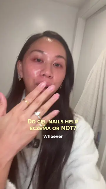 To any of my itchy sisters, help ya girl out 🥺💅✨ #eczemaawareness #eczemaflare