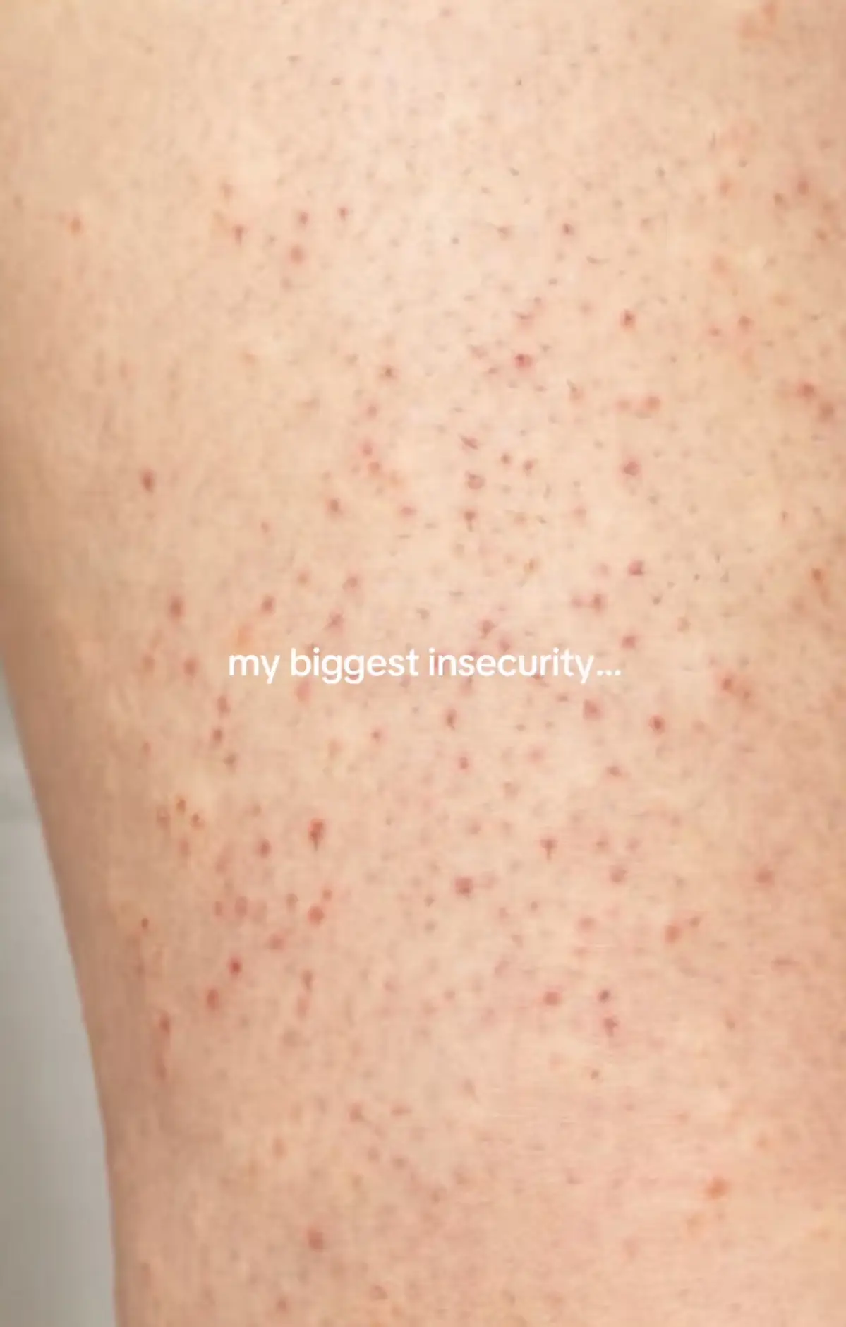 how to get silky smooth bump free skin for summer #skintok #bumpyskin #kptreatme