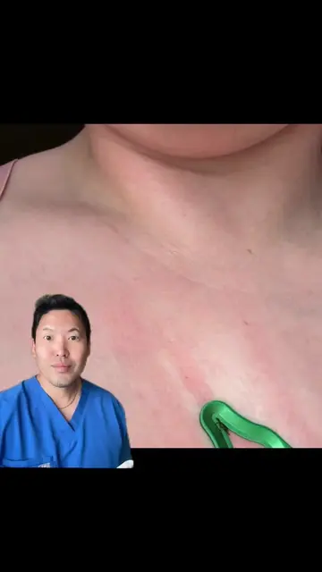 This green tick removal tool can be helpful, but technique matters 👀 It probabl