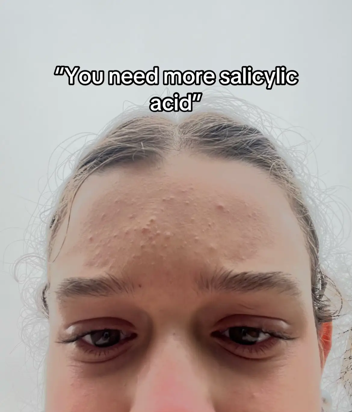 Stop overcomplicating your skincare routine and hear me out➡️ I suffered from ac