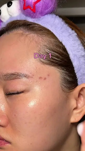 Try this acne cream for just one week. @APLIN Store US #kbeauty #skintok #acnepr
