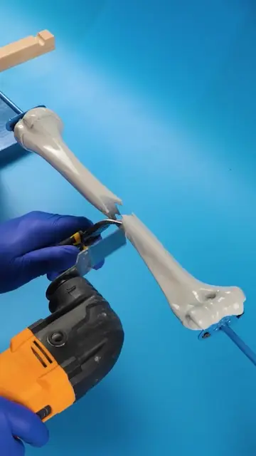 🔍 A Simple Guide to Growth Surgery! 🦴 #educational #howto #pov #hospital #fyp 