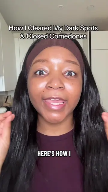 If you’re struggling with dark spots, closed comedones, and dull skin, this is e