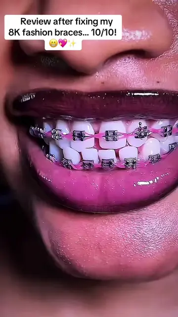Only ₦8,000 for the cutest fashion braces you’ll see today! 🎀 Available in diff