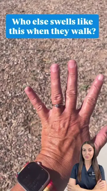 Ever finish a walk and realize your rings suddenly don't fit? Most people assume