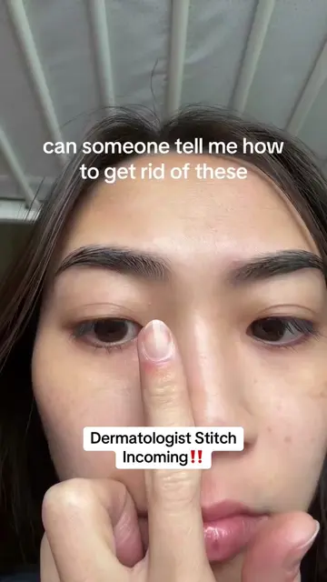 Those teeny tiny bumps under your skin that won’t pop like a normal pimple? Prob