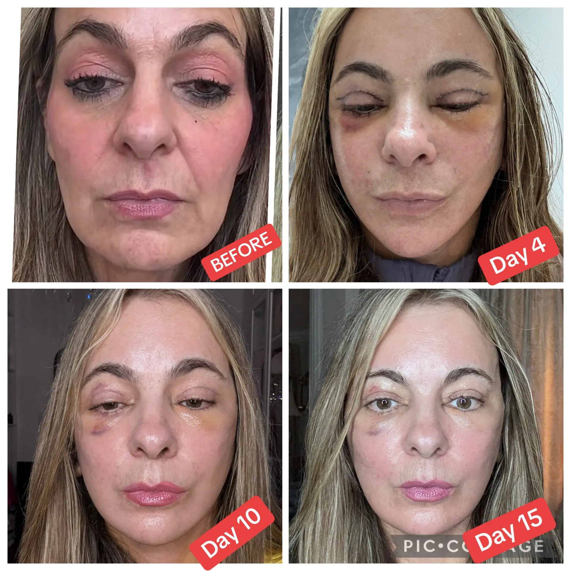 Progress before and after photos of a deep plane facelift, neck, lift endoscopic