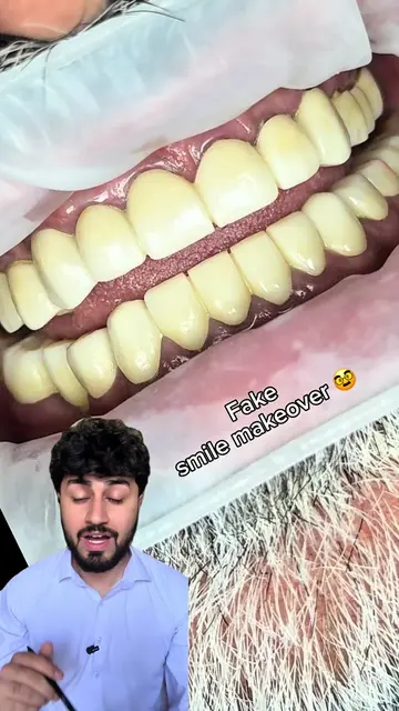 Transformation from fake smile makeover to natural looking smile makeover 🇵🇰🇬