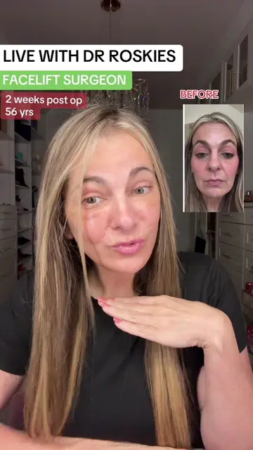 Live on TikTok with Dr Mike Roskies, discussing my specific surgery, as well as 