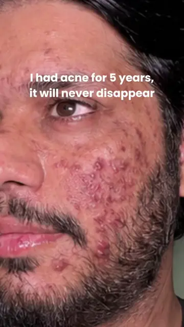 Earlier i thought i will not gonna see my clear skin… but how far i came with @D