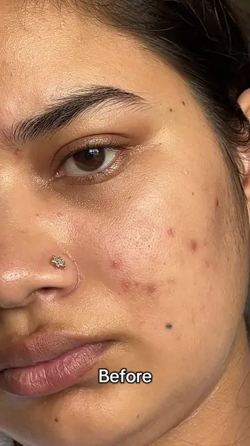 10 days with  @IUNIK Beta-Glucan Hydrated, plump, calm skin the difference is re
