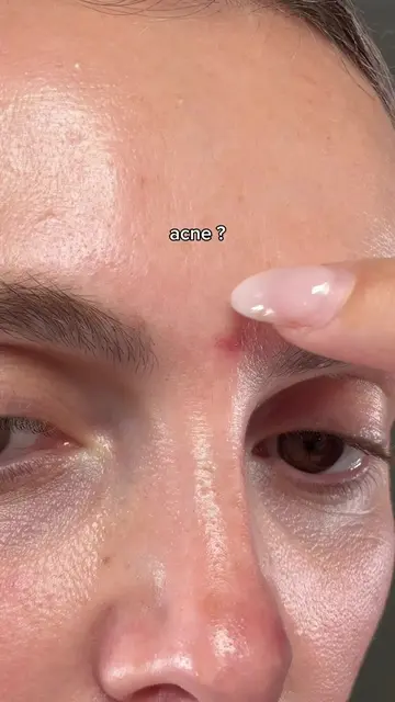 Acne fade in 5 days with @Arencia  #skin #skincare #arencia #acne #kbeauty