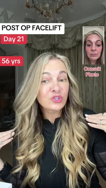 Day 22 post op deep plane facelift surgery. Facelift journal and diary on recove